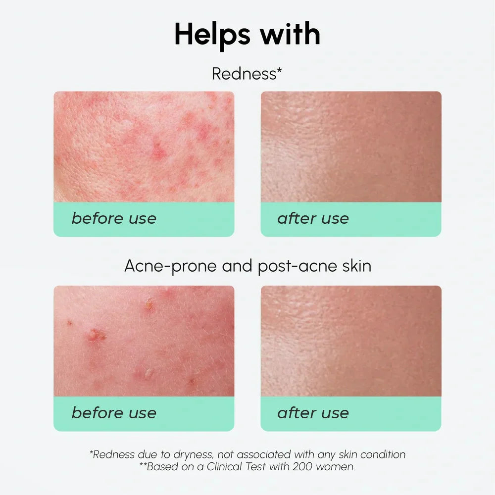 Redness Soothing Azelaic Acid Serum